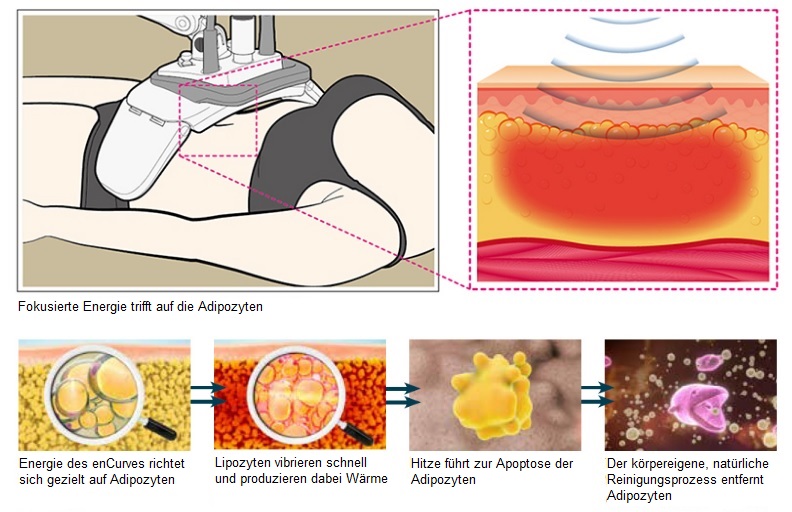 enCurve Behandlung